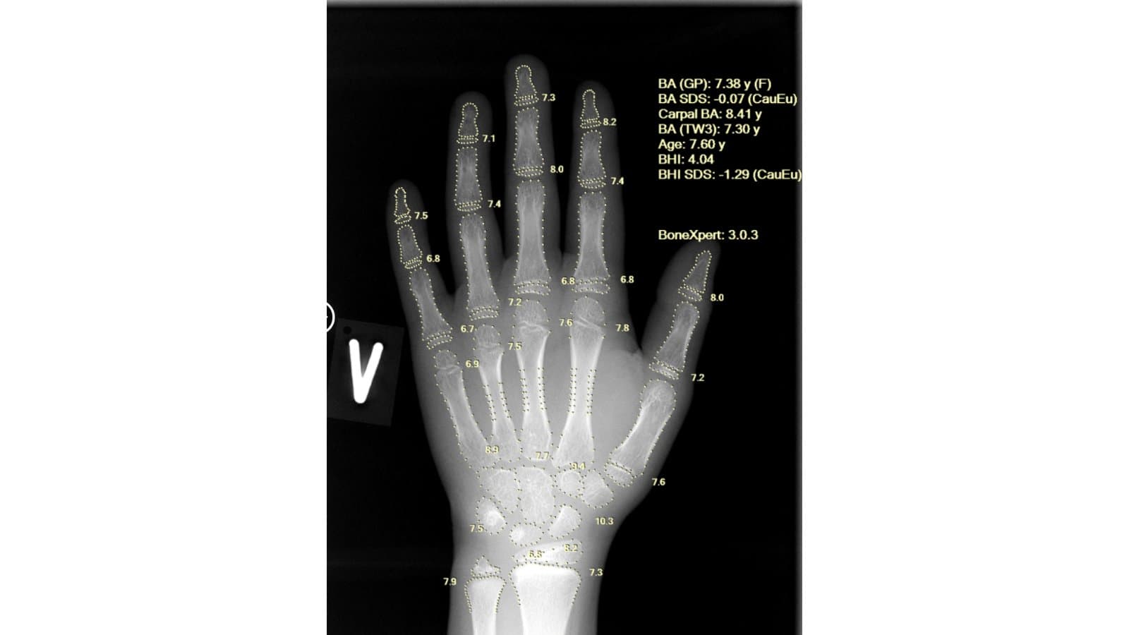 Aarthi Scans & Labs Implements BoneXpert AI Bone Age Analysis Across 100 Diagnostic Centres Nationwide